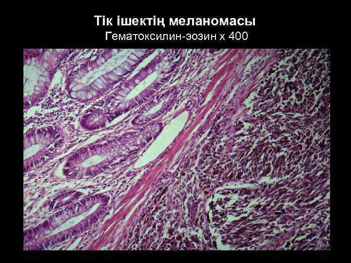 Тік ішектің меланомасы Гематоксилин-эозин х 400 