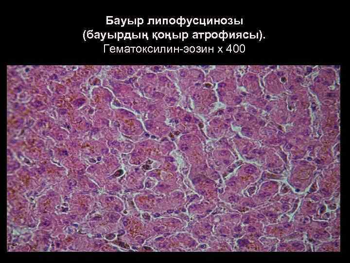 Бауыр липофусцинозы (бауырдың қоңыр атрофиясы). Гематоксилин-эозин х 400 