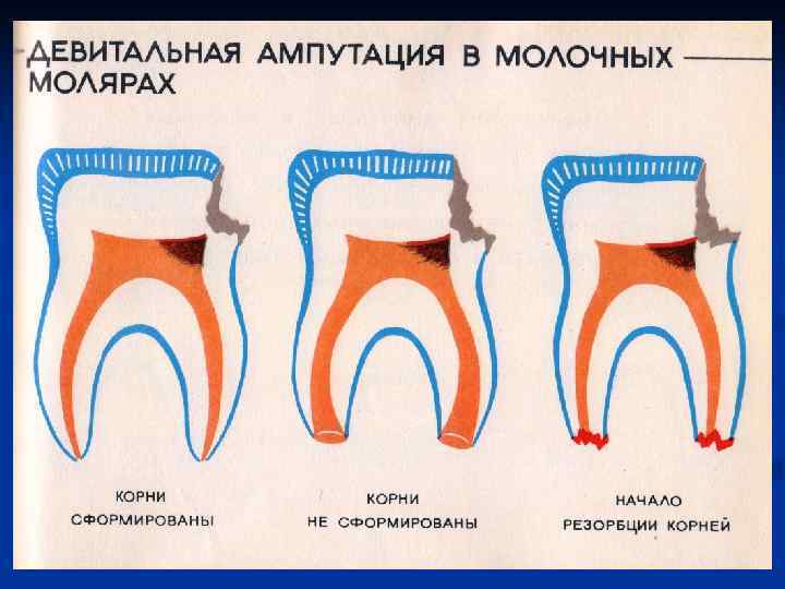 Этапы витальной ампутации пульпы схема