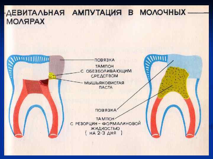 Этапы витальной ампутации пульпы схема