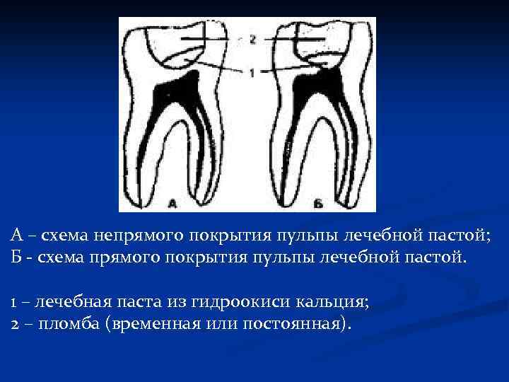 А – схема непрямого покрытия пульпы лечебной пастой; Б - схема прямого покрытия пульпы