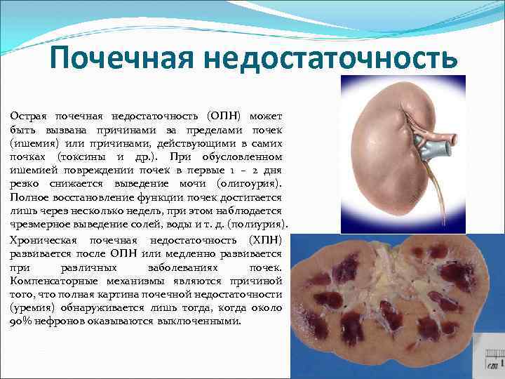 Почечная недостаточность Острая почечная недостаточность (ОПН) может быть вызвана причинами за пределами почек (ишемия)