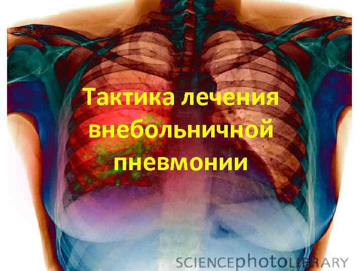 Тактика лечения внебольничной пневмонии 