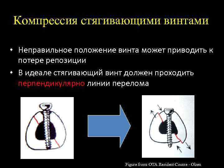 Компрессия стягивающими винтами • Неправильное положение винта может приводить к потере репозиции • В