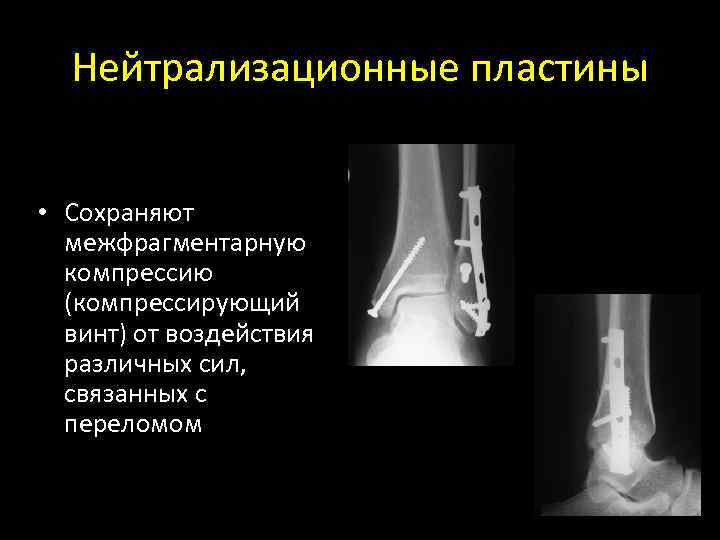 Нейтрализационные пластины • Сохраняют межфрагментарную компрессию (компрессирующий винт) от воздействия различных сил, связанных с