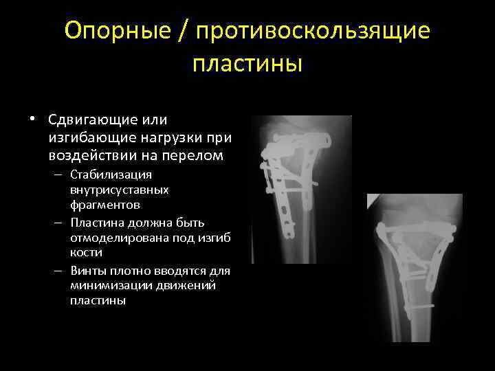 Опорные / противоскользящие пластины • Сдвигающие или изгибающие нагрузки при воздействии на перелом –