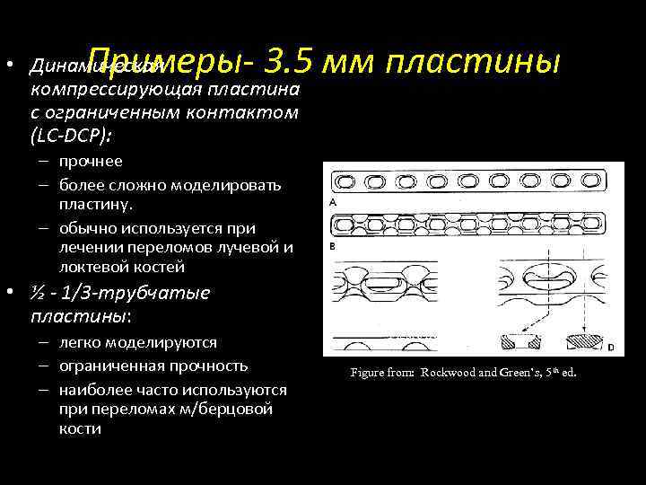 Примеры- 3. 5 мм пластины • Динамическая компрессирующая пластина с ограниченным контактом (LC-DCP): –