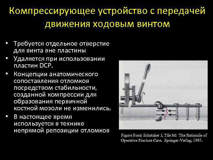 Компрессирующее устройство с передачей движения ходовым винтом • Требуется отдельное отверстие для винта вне