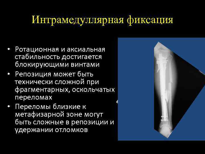 Интрамедуллярная фиксация • Ротационная и аксиальная стабильность достигается блокирующими винтами • Репозиция может быть