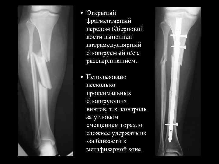 Перелом большой берцовой кости