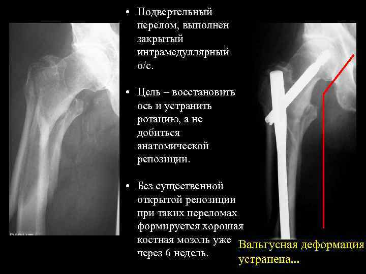 Подвертельный перелом. Зоны роста плечевой кости. Костная мозоль плечевой кости рентген. Ротация плечевой кости рентген. Зона роста кости на рентгене плечевой кости.