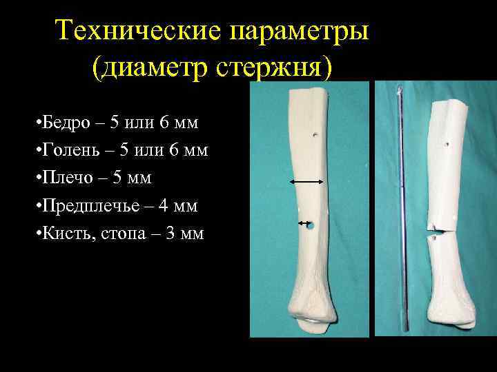 Технические параметры (диаметр стержня) • Бедро – 5 или 6 мм • Голень –