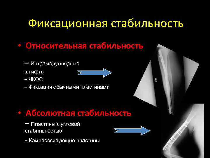 Фиксационная стабильность • Относительная стабильность – Интрамедуллярные штифты – ЧКОС – Фиксация обычными пластинами