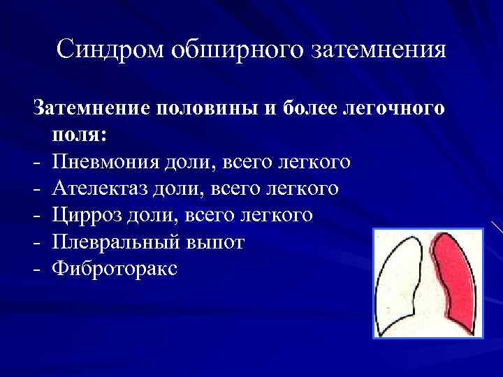 Синдром обширного затемнения Затемнение половины и более легочного поля: - Пневмония доли, всего легкого