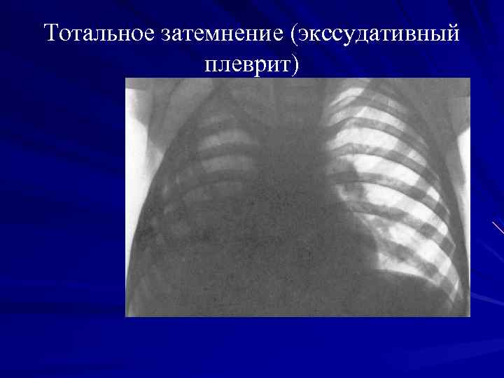 Тотальное затемнение (экссудативный плеврит) 