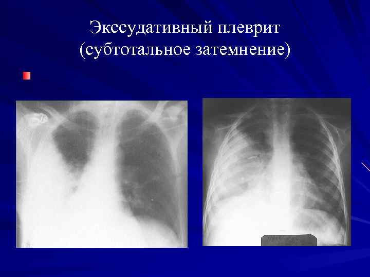 Рентгенологическая картина при экссудативном плеврите