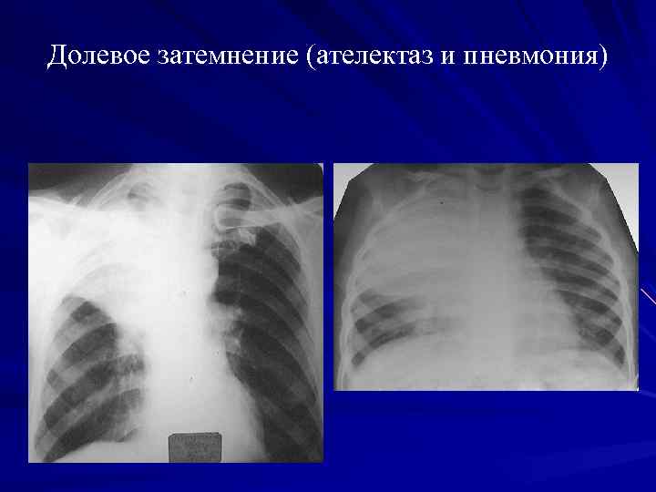 Долевое затемнение (ателектаз и пневмония) 