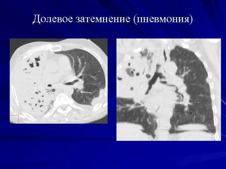 Рентгенологическая картина пневмонии лучевая диагностика
