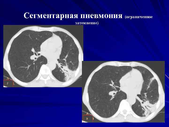 Сегментарная пневмония (ограниченное затемнение) 