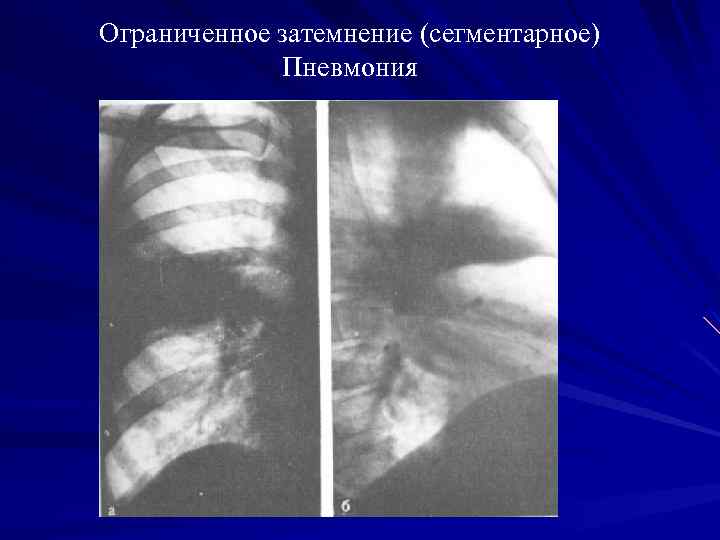 Лучевая диагностика легких презентация