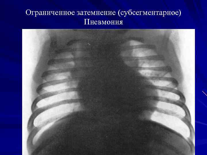 Ограниченное затемнение (субсегментарное) Пневмония 