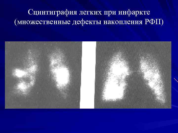 Сцинтиграфия легких при инфаркте (множественные дефекты накопления РФП) 