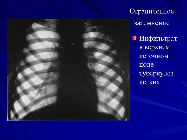 Лучевая диагностика легких презентация