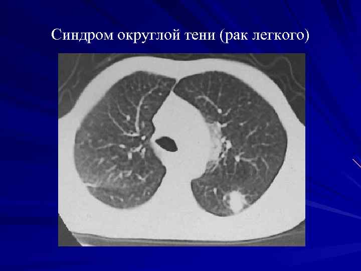 Синдром округлой тени (рак легкого) 