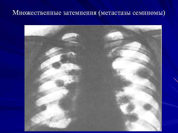 Множественные затемнения (метастазы семиномы) 