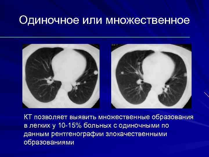 Лучевая диагностика заболеваний легких презентация