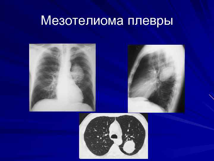 Мезотелиома плевры кт картина