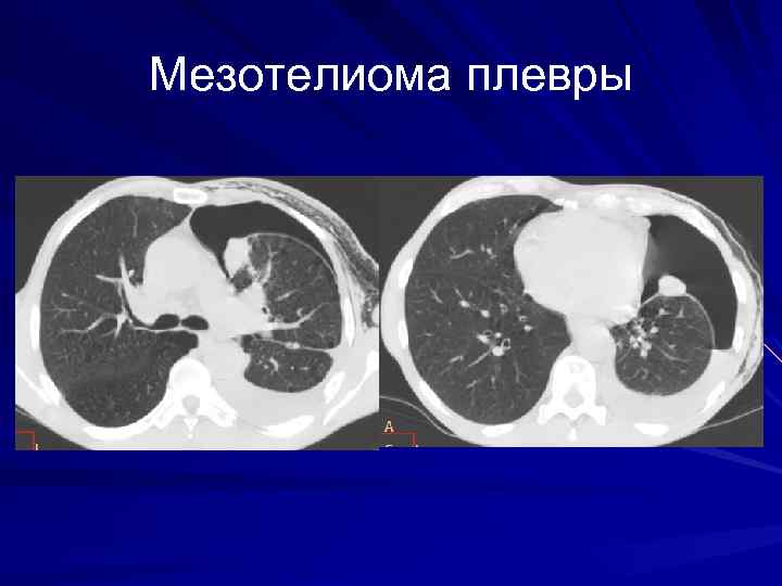 Мезотелиома плевры 