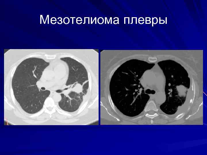 Мезотелиома плевры кт картина