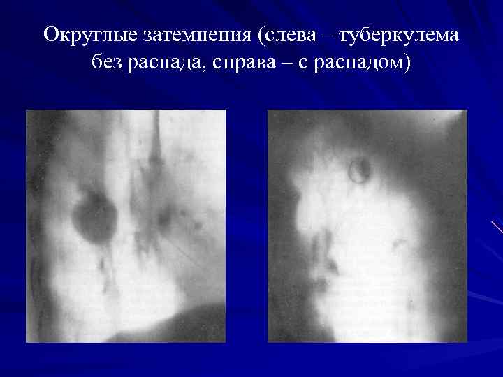 Узловое образование правого легкого