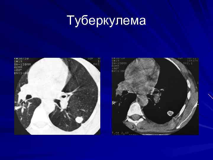 Туберкулема 