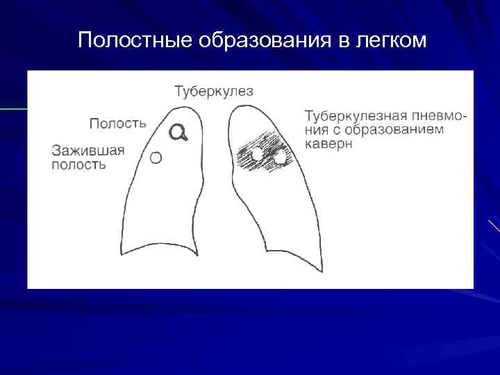 Полостные образования в легком 