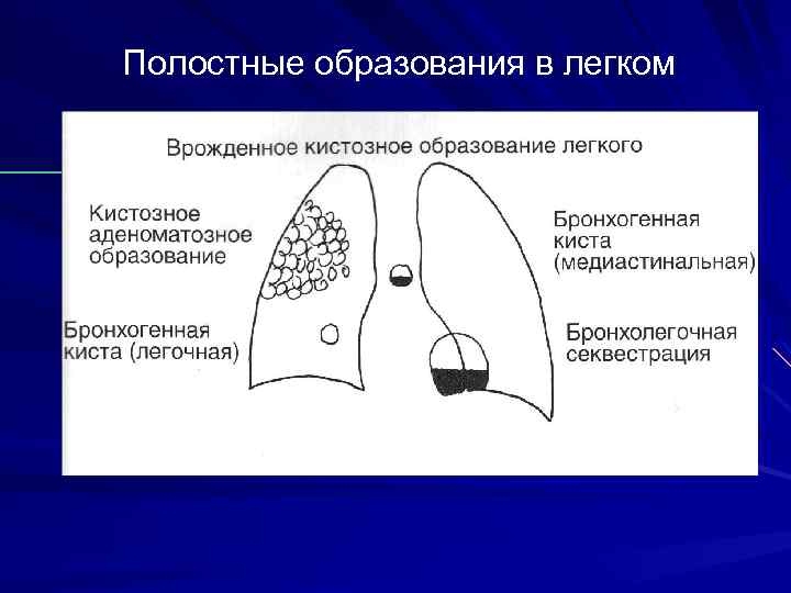 Образование в легком