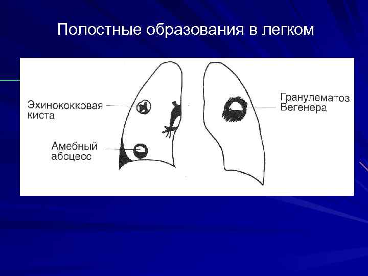 Полостные образования в легком 