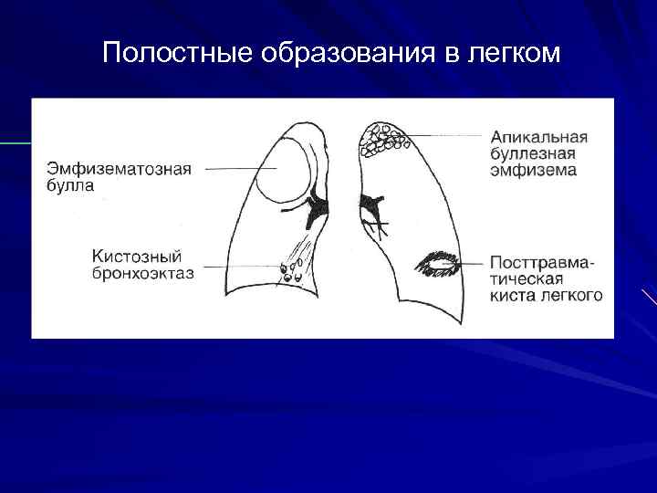 Полостные образования в легком 