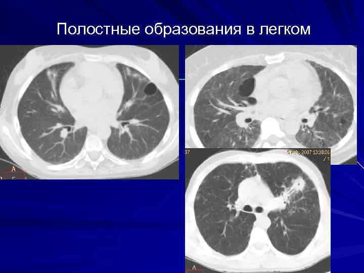 Полостные образования в легком 
