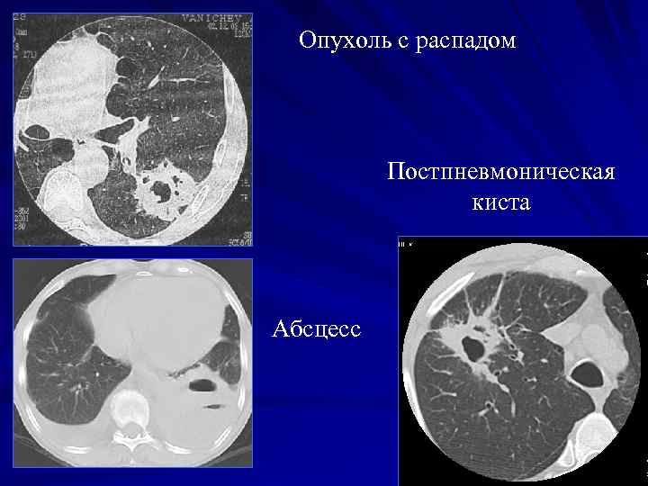 Распад опухоли что это означает в онкологии