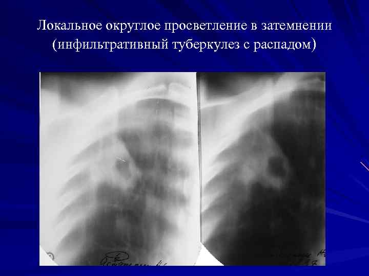 Локальное округлое просветление в затемнении (инфильтративный туберкулез с распадом) 