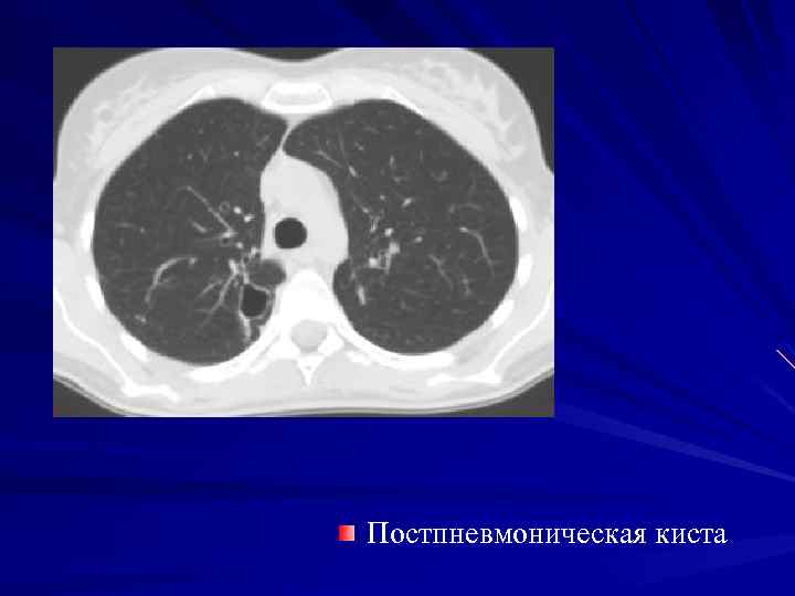Постпневмоническая киста 