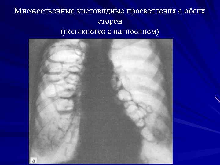 Для рентгенологической картины фолликулярной кисты характерна деструкция костной ткани