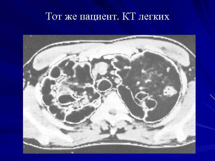 Тот же пациент. КТ легких 