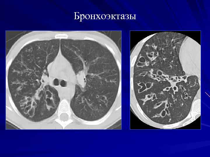 Кт картина бронхоэктазов