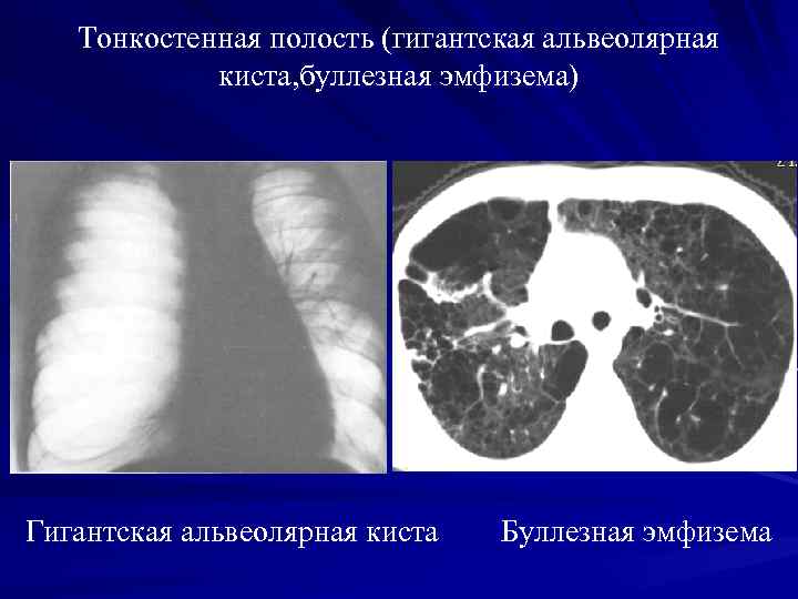 Буллы в легких рентгенологическая картина