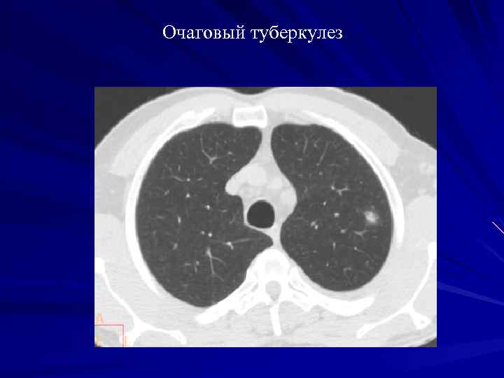 Очаговые изменения в легких на кт. Очаговый туберкулез компьютерная томография. Инфильтративный туберкулез на кт.