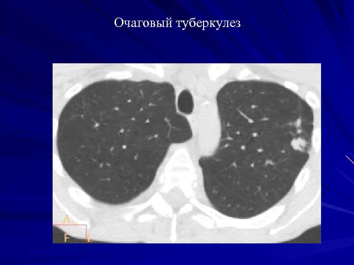 Картина очаговых. Очаговый туберкулез компьютерная томография. Очаговый туберкулез легких на кт. Очаговый туберкулёз лёгких кт. Очагово-инфильтративный туберкулез кт.