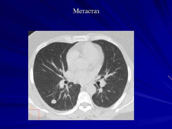 Метастаз 